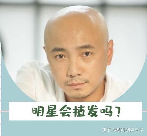 明星植发圈内爆料合集,圈内爆料合集深度解析 第2张 明星植发圈内爆料合集,圈内爆料合集深度解析 第2张